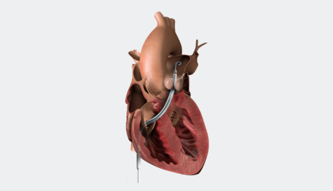 Impella RP.png