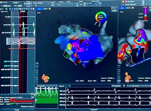 Elektroda ablacyjna widoczny na mapie systemu obrazowania elektroanatomicznego..jpeg