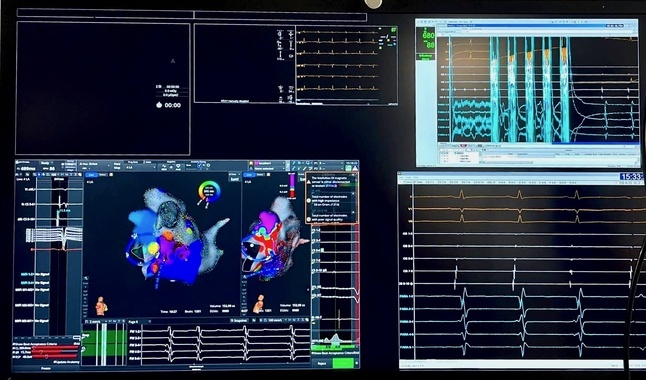 Moment wykonania elektroporacji nawigowanej systemem obrazowania elektroanatomicznego.jpeg